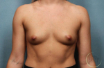 Breast Augmentation Case 4 Before
